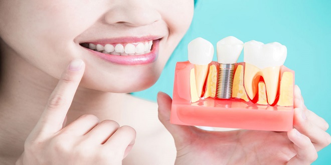 Dental Implants 101