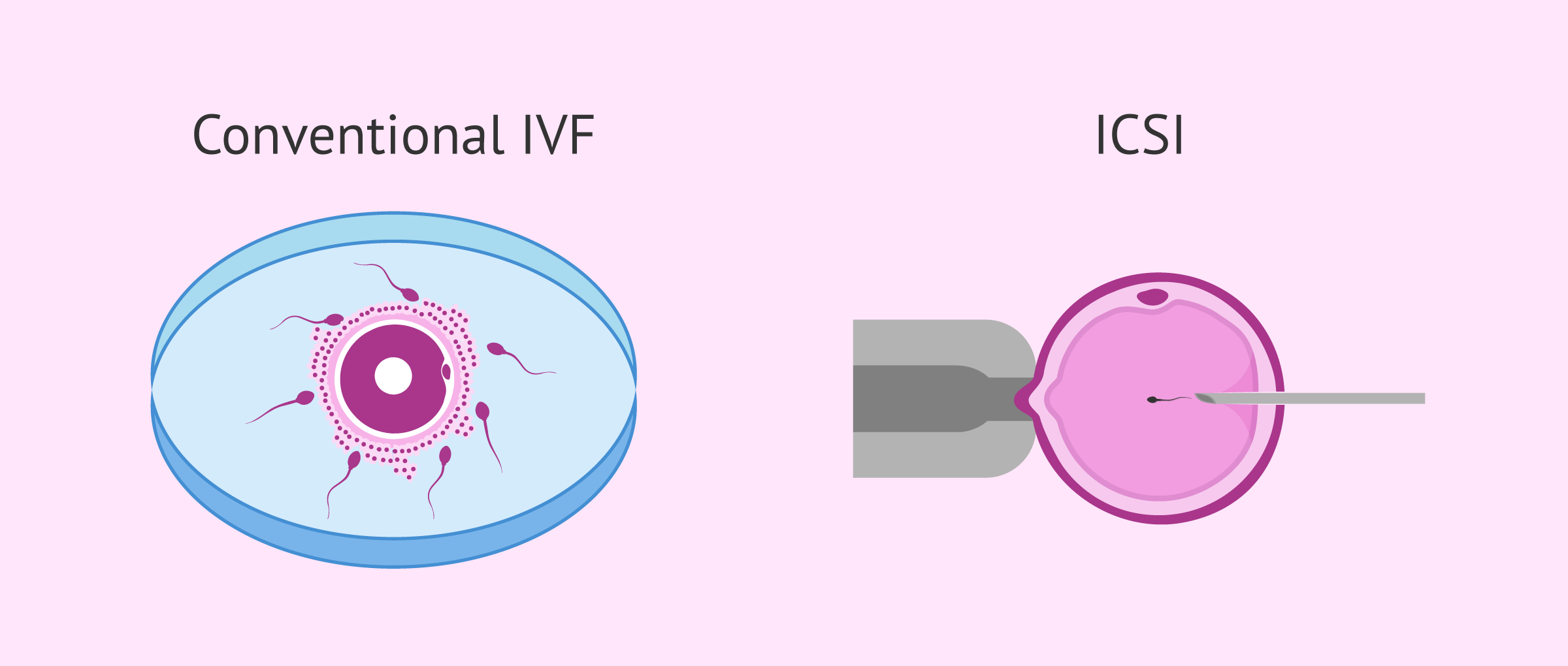IVF Overview and Definition: A Complete Guide to Understanding In Vitro Fertilization